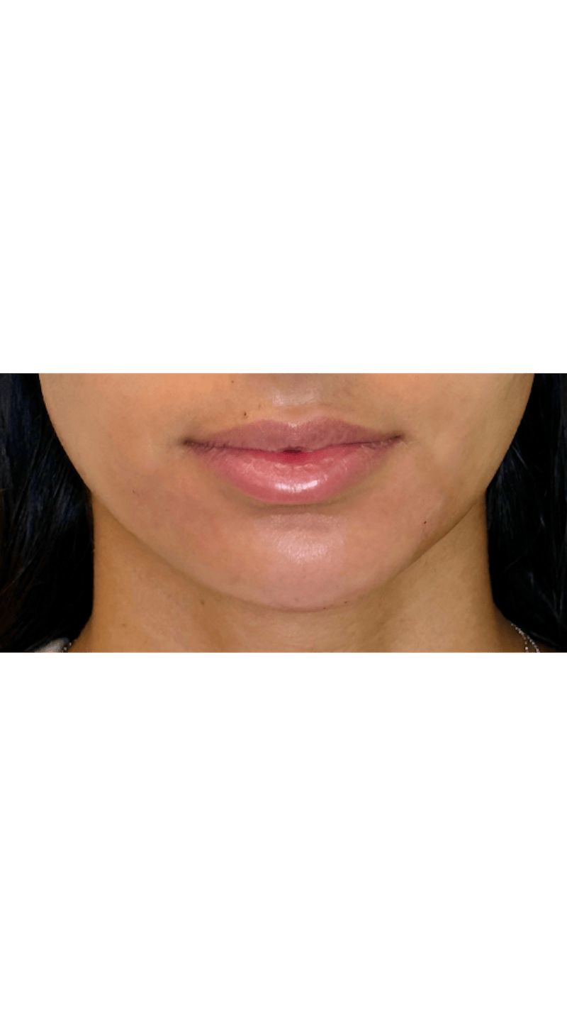Facial Balancing Before & After Gallery - Patient 159405 - Image 4