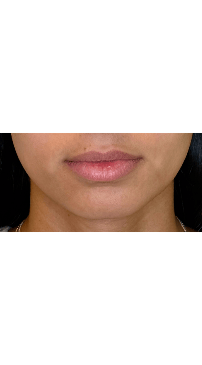 Facial Balancing Before & After Gallery - Patient 159405 - Image 3