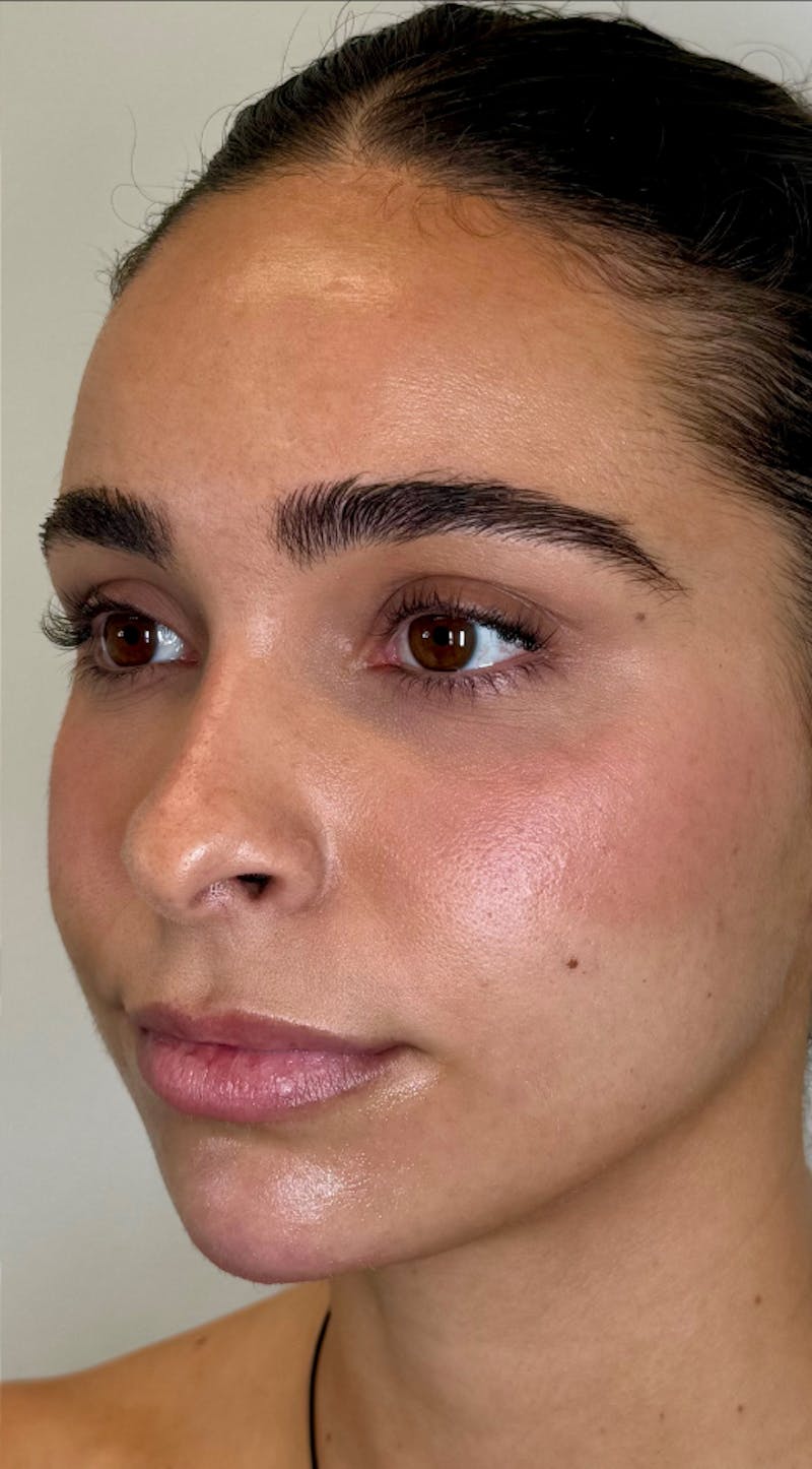 Facial Filler Before & After Gallery - Patient 976577 - Image 4