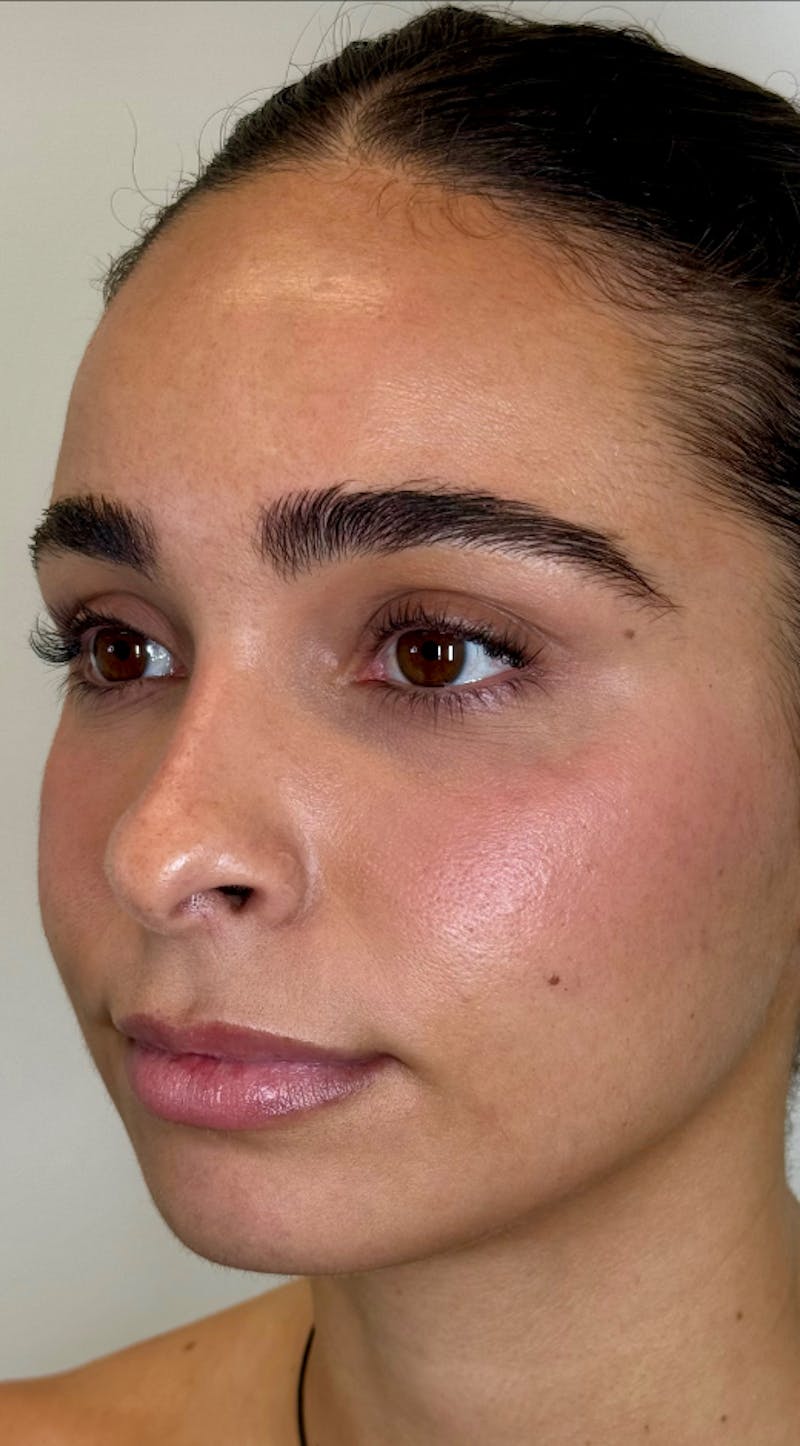 Facial Filler Before & After Gallery - Patient 976577 - Image 3