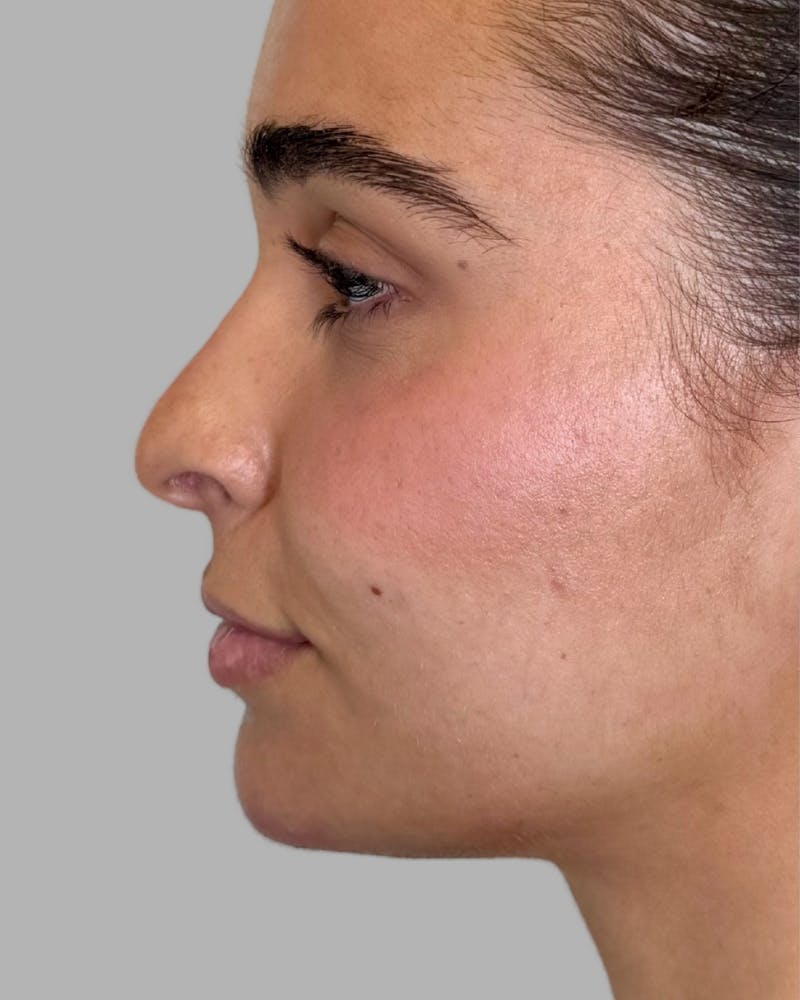 Facial Filler Before & After Gallery - Patient 976577 - Image 2