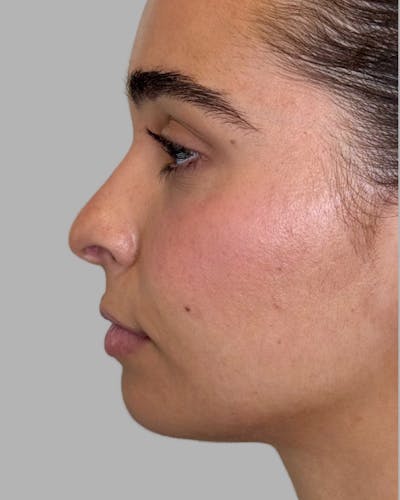Facial Filler Before & After Gallery - Patient 976577 - Image 1