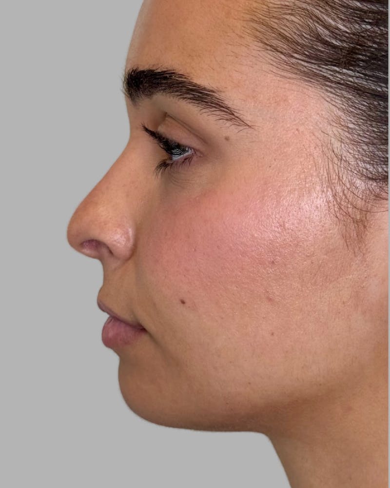 Facial Filler Before & After Gallery - Patient 976577 - Image 1
