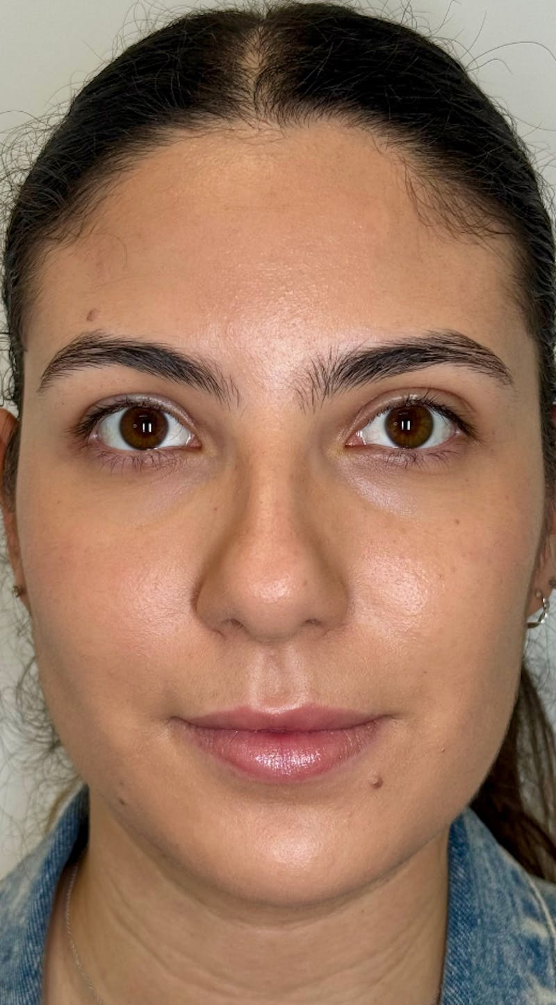 Facial Balancing Before & After Gallery - Patient 318462 - Image 2