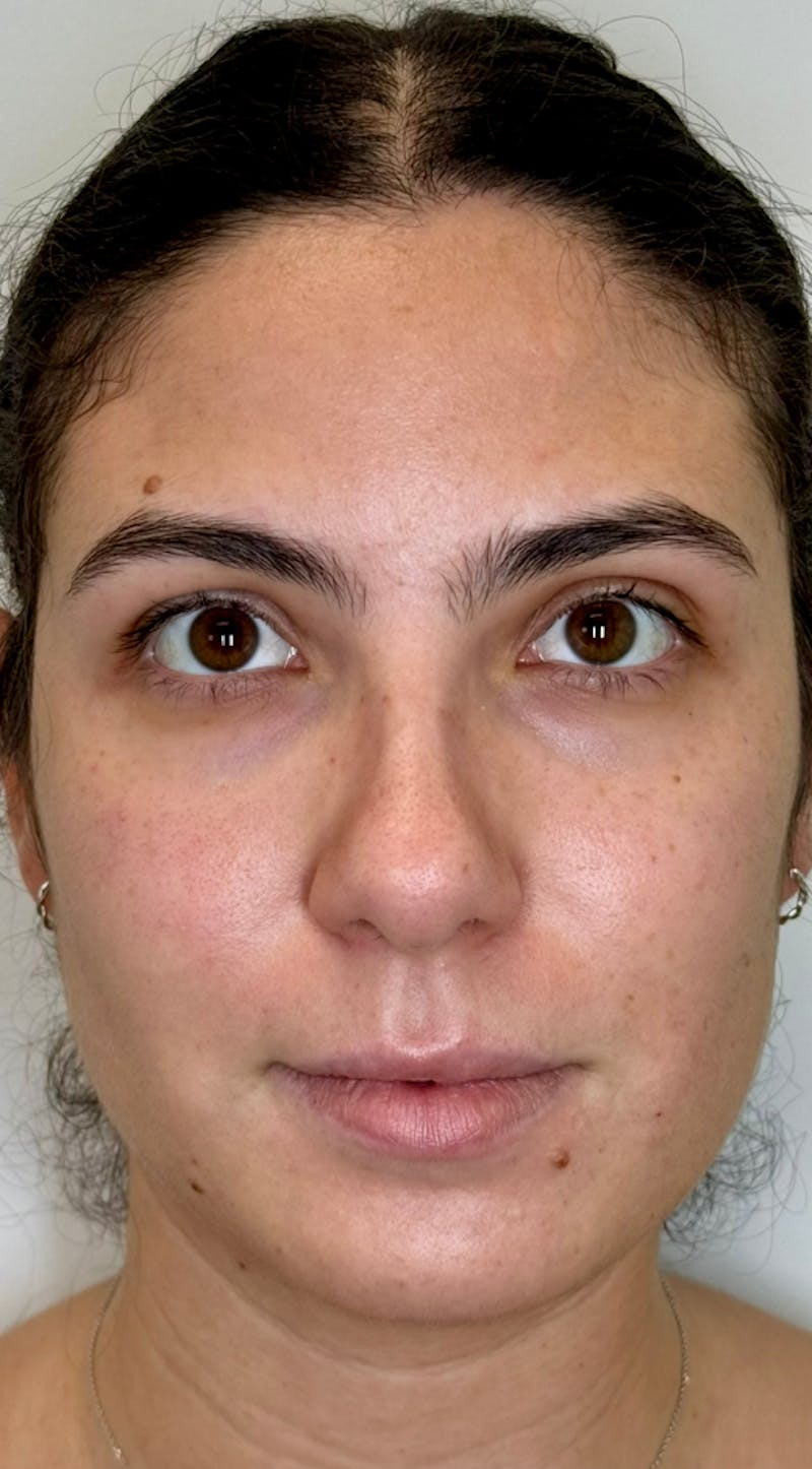 Facial Balancing Before & After Gallery - Patient 318462 - Image 1