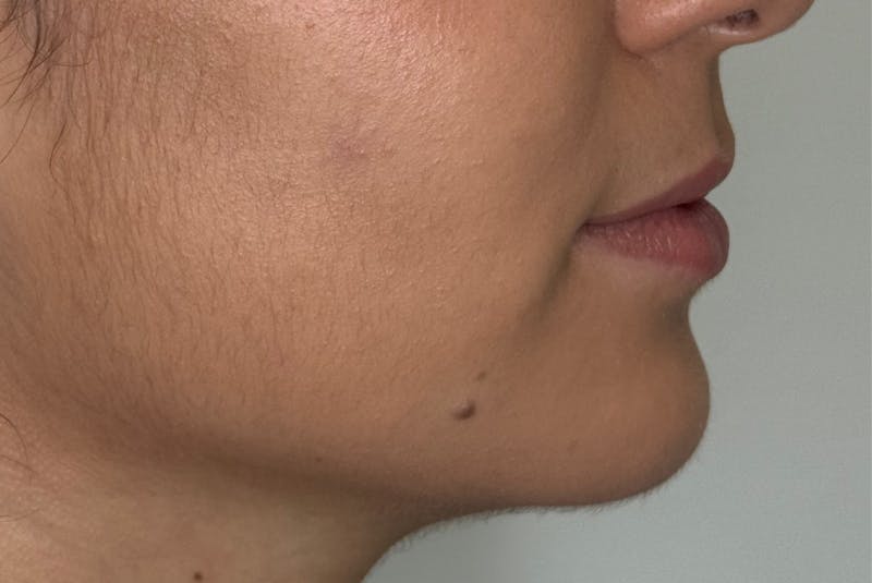 BOTOX Before & After Gallery - Patient 181080 - Image 6