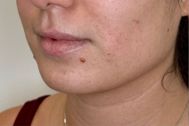 BOTOX Before & After Gallery - Patient 181080 - Image 3