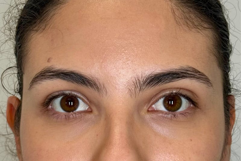 BOTOX Before & After Gallery - Patient 181080 - Image 2