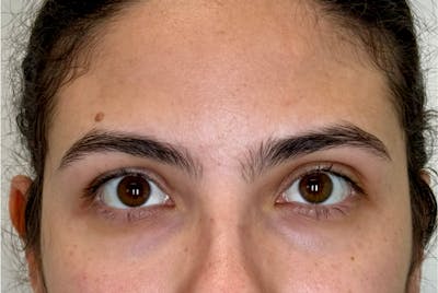 BOTOX Before & After Gallery - Patient 181080 - Image 1