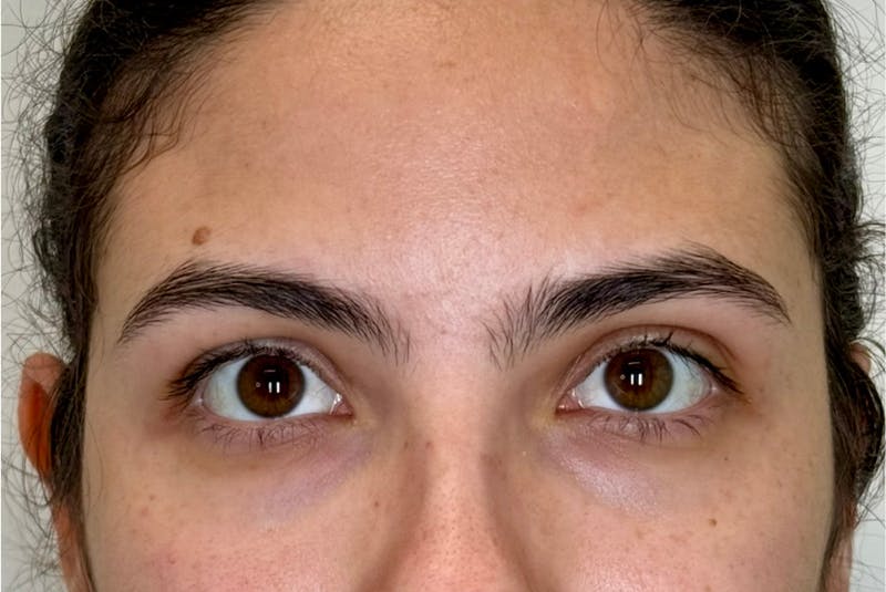 BOTOX Before & After Gallery - Patient 181080 - Image 1