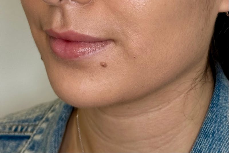 BOTOX Before & After Gallery - Patient 181080 - Image 4