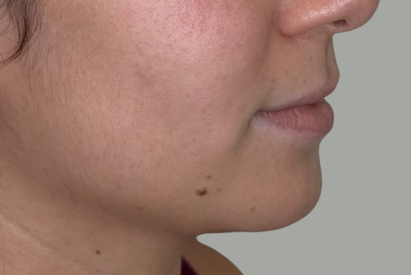 BOTOX Before & After Gallery - Patient 181080 - Image 5
