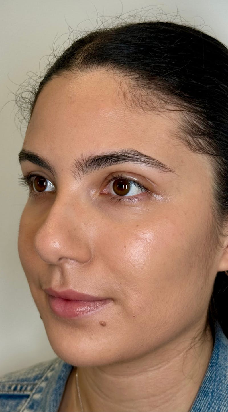 Facial Balancing Before & After Gallery - Patient 318462 - Image 4