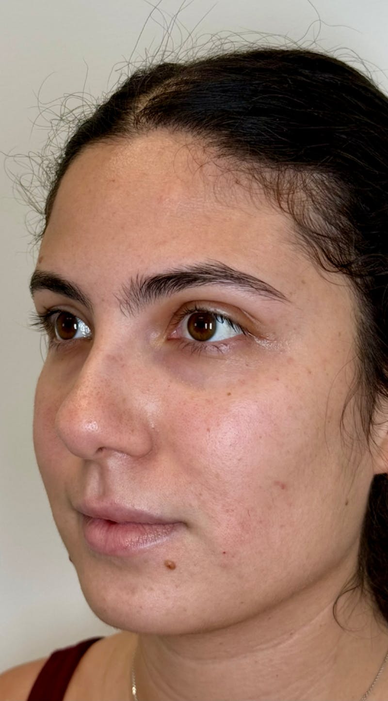 Facial Balancing Before & After Gallery - Patient 318462 - Image 3