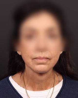 Neck Lift Before & After Gallery - Patient 842173 - Image 4