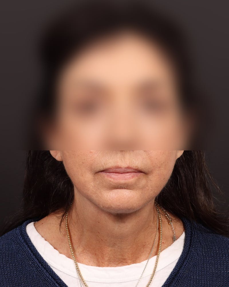 Neck Lift Before & After Gallery - Patient 842173 - Image 4