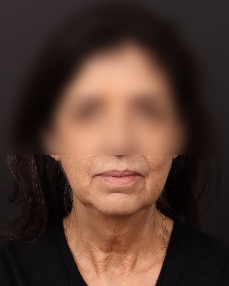 Neck Lift Before & After Gallery - Patient 842173 - Image 3