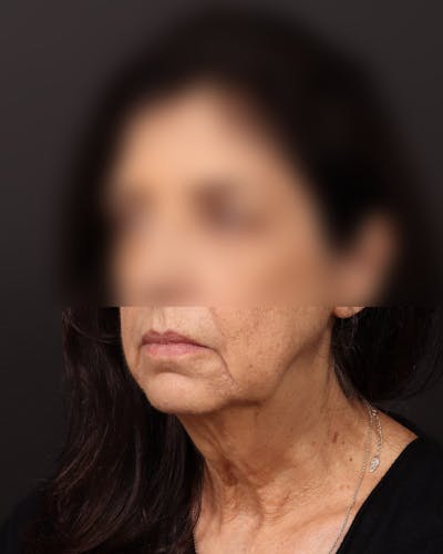 Neck Lift Before & After Gallery - Patient 842173 - Image 1