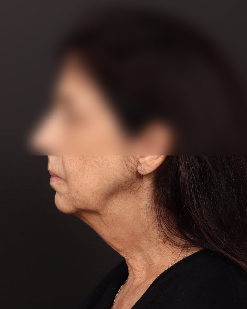 Neck Lift Before & After Gallery - Patient 842173 - Image 5