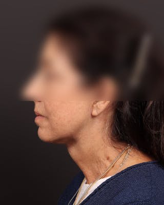 Neck Lift Before & After Gallery - Patient 842173 - Image 6
