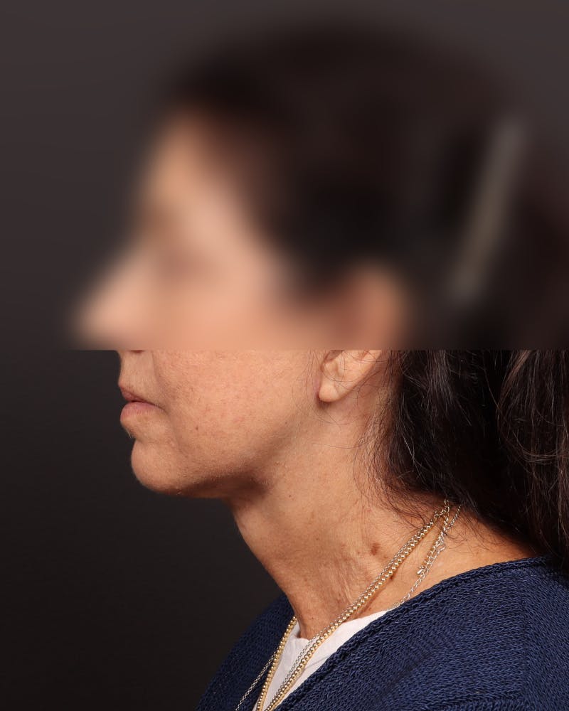 Neck Lift Before & After Gallery - Patient 842173 - Image 6