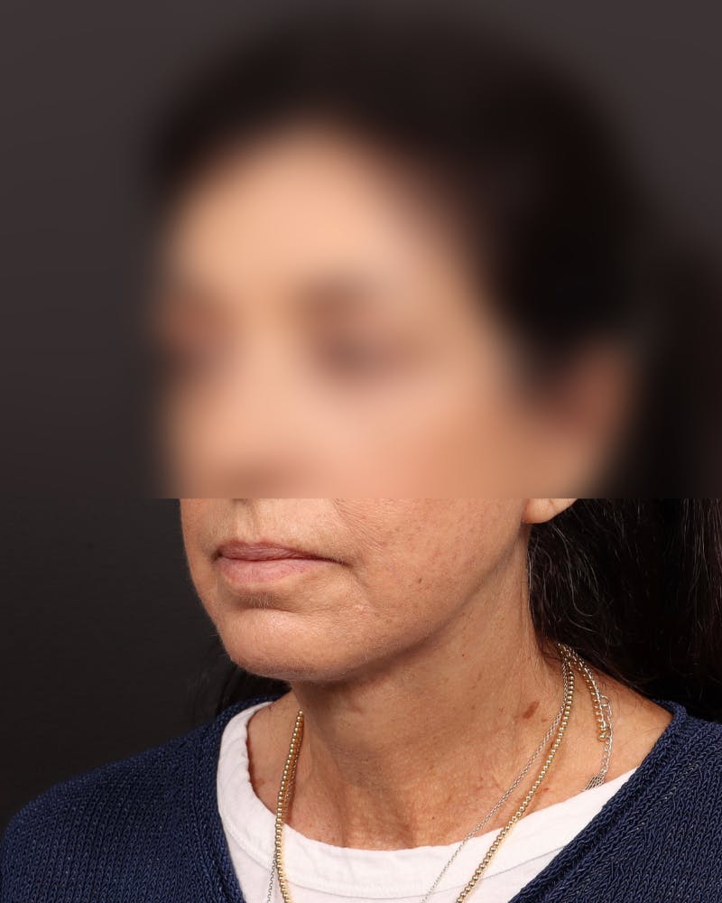 Neck Lift Before & After Gallery - Patient 842173 - Image 2