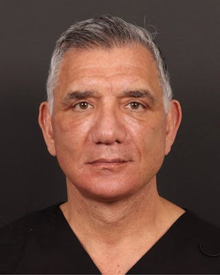 Facelift Before & After Gallery - Patient 381038 - Image 2