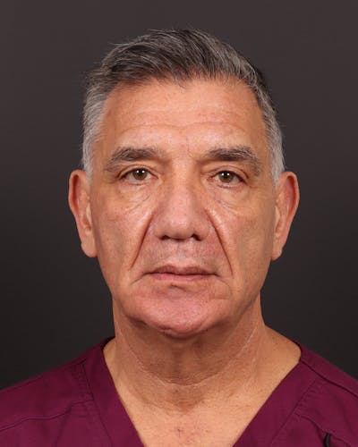 Facelift Before & After Gallery - Patient 381038 - Image 1