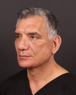 Facelift Before & After Gallery - Patient 381038 - Image 4