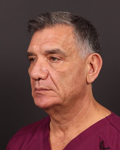 Neck Lift Before & After Gallery - Patient 190254 - Image 1