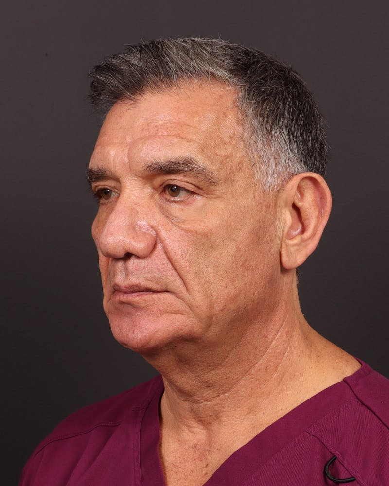 Facelift Before & After Gallery - Patient 381038 - Image 3