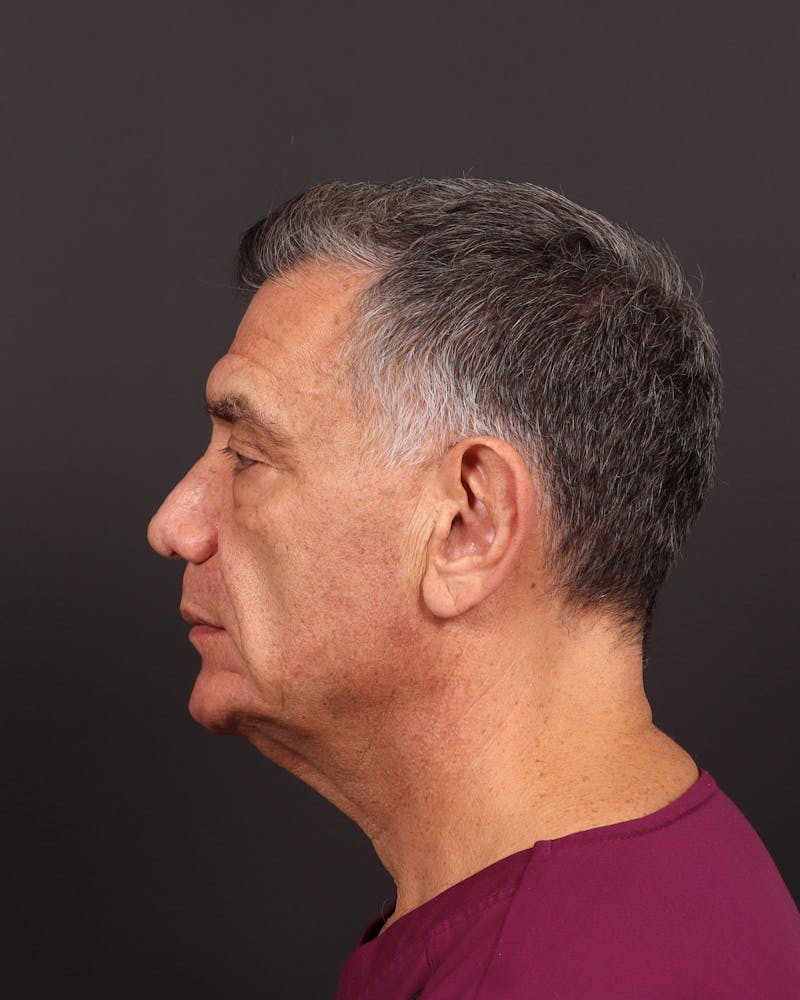 Facelift Before & After Gallery - Patient 381038 - Image 5