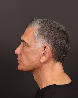 Facelift Before & After Gallery - Patient 381038 - Image 6