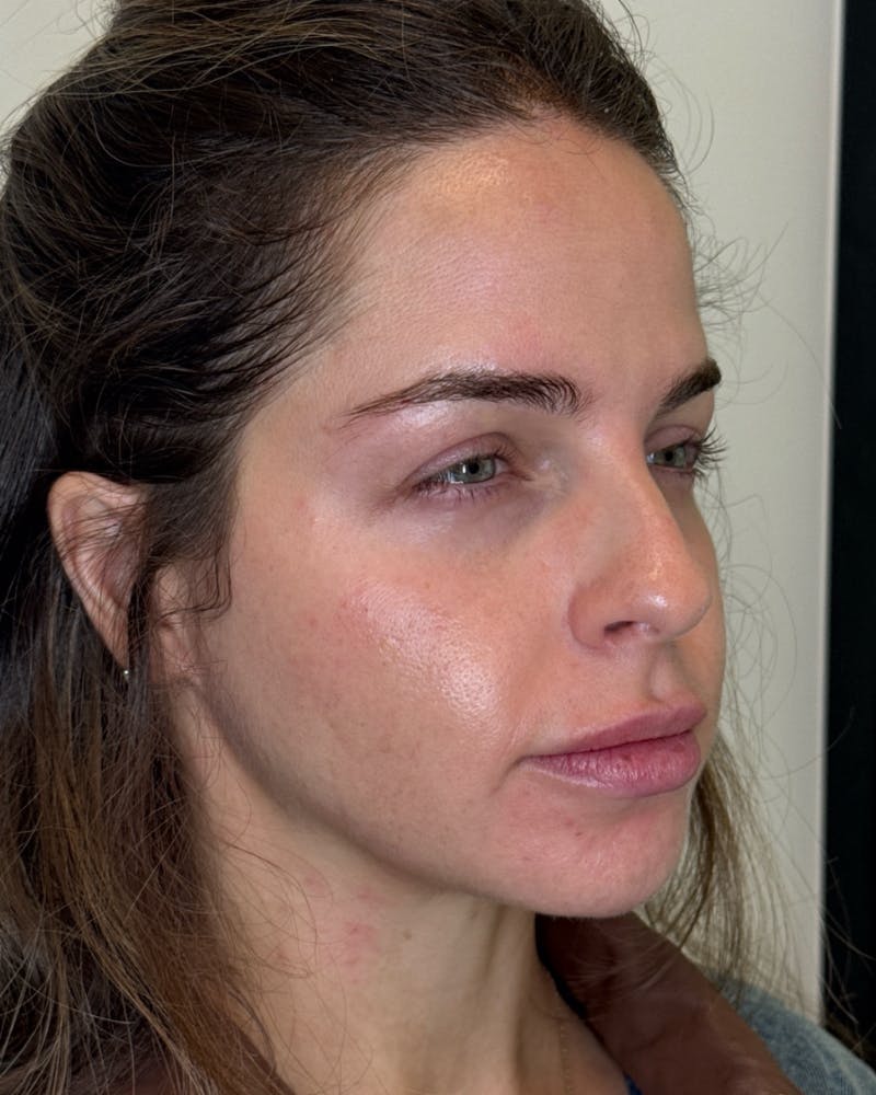 BOTOX Before & After Gallery - Patient 484009 - Image 1