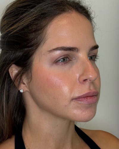 Nefertiti Neck Lift Before & After Gallery - Patient 606205 - Image 2