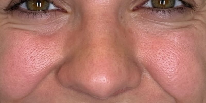 Dysport Before & After Gallery - Patient 290630 - Image 1