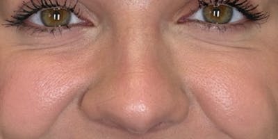 Dysport Before & After Gallery - Patient 290630 - Image 2