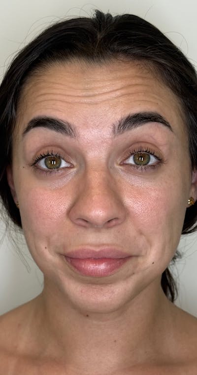 Facial Balancing Before & After Gallery - Patient 319721 - Image 1