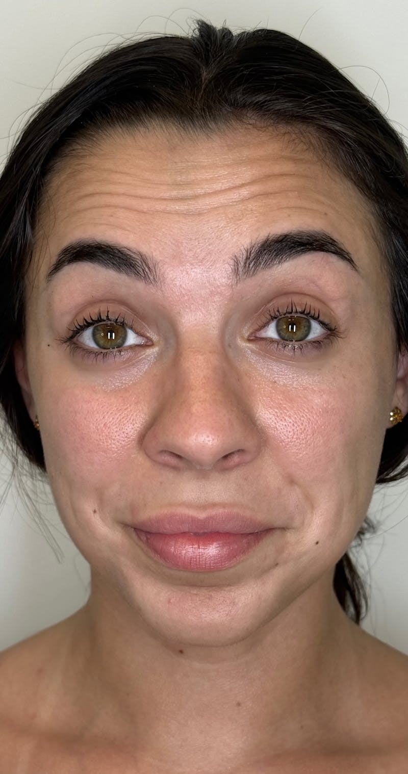 Facial Balancing Before & After Gallery - Patient 319721 - Image 1