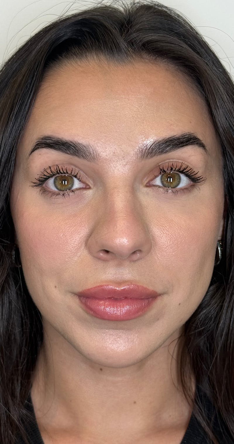 Facial Balancing Before & After Gallery - Patient 319721 - Image 2
