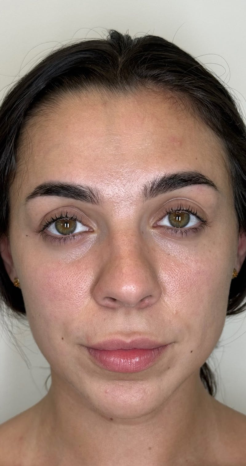 Facial Balancing Before & After Gallery - Patient 319721 - Image 3