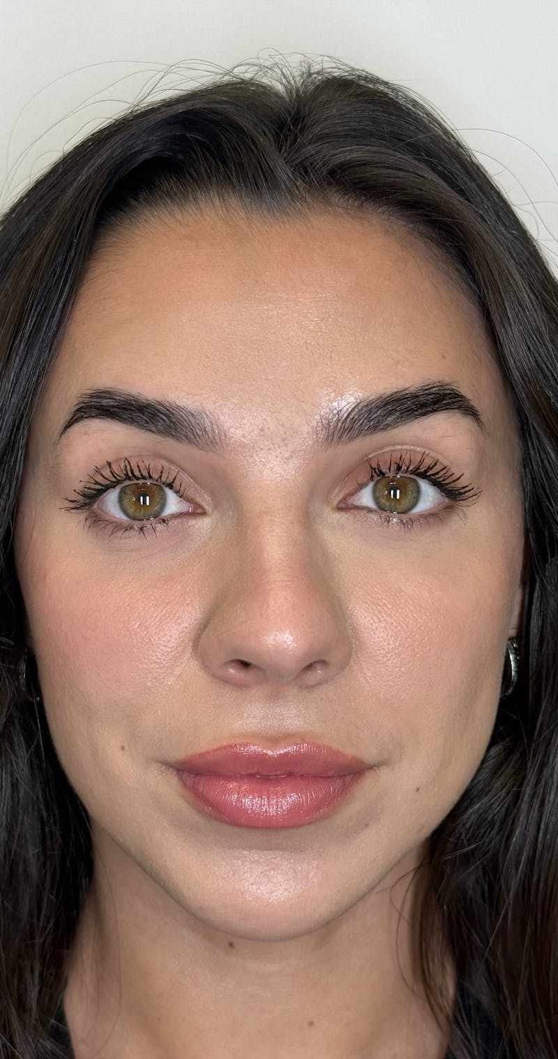 Facial Balancing Before & After Gallery - Patient 319721 - Image 4