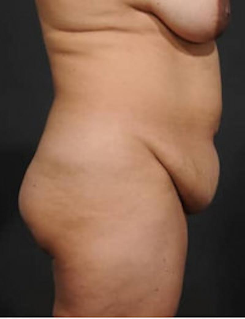 Tummy Tuck Before & After Gallery - Patient 133214394 - Image 3