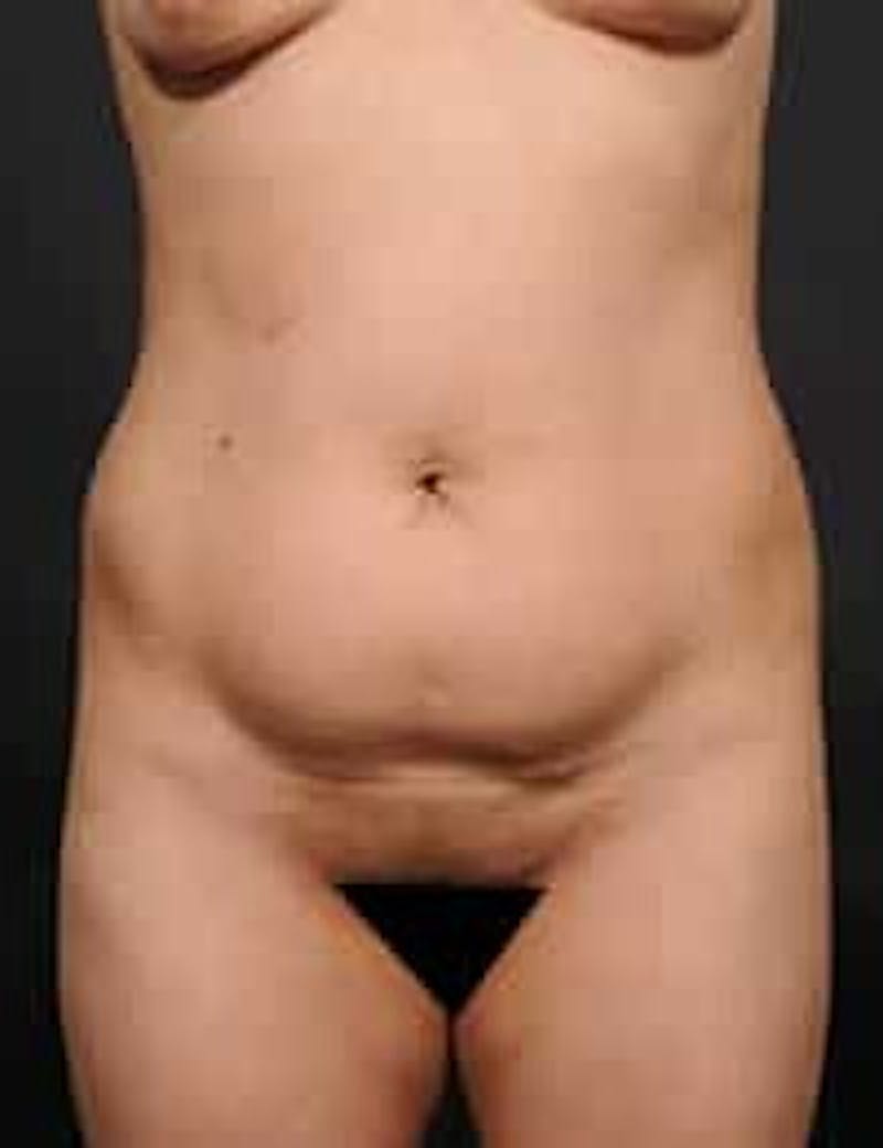 Tummy Tuck Before & After Gallery - Patient 133214396 - Image 1