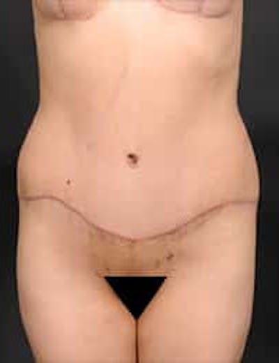 Tummy Tuck Before & After Gallery - Patient 133214396 - Image 2