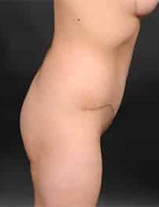 Tummy Tuck Before & After Gallery - Patient 133214396 - Image 4