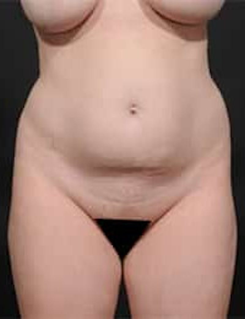 Tummy Tuck Before & After Gallery - Patient 133214397 - Image 1