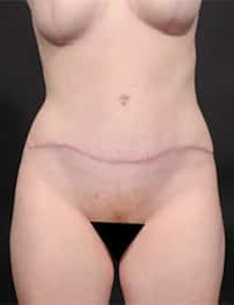 Tummy Tuck Before & After Gallery - Patient 133214397 - Image 2