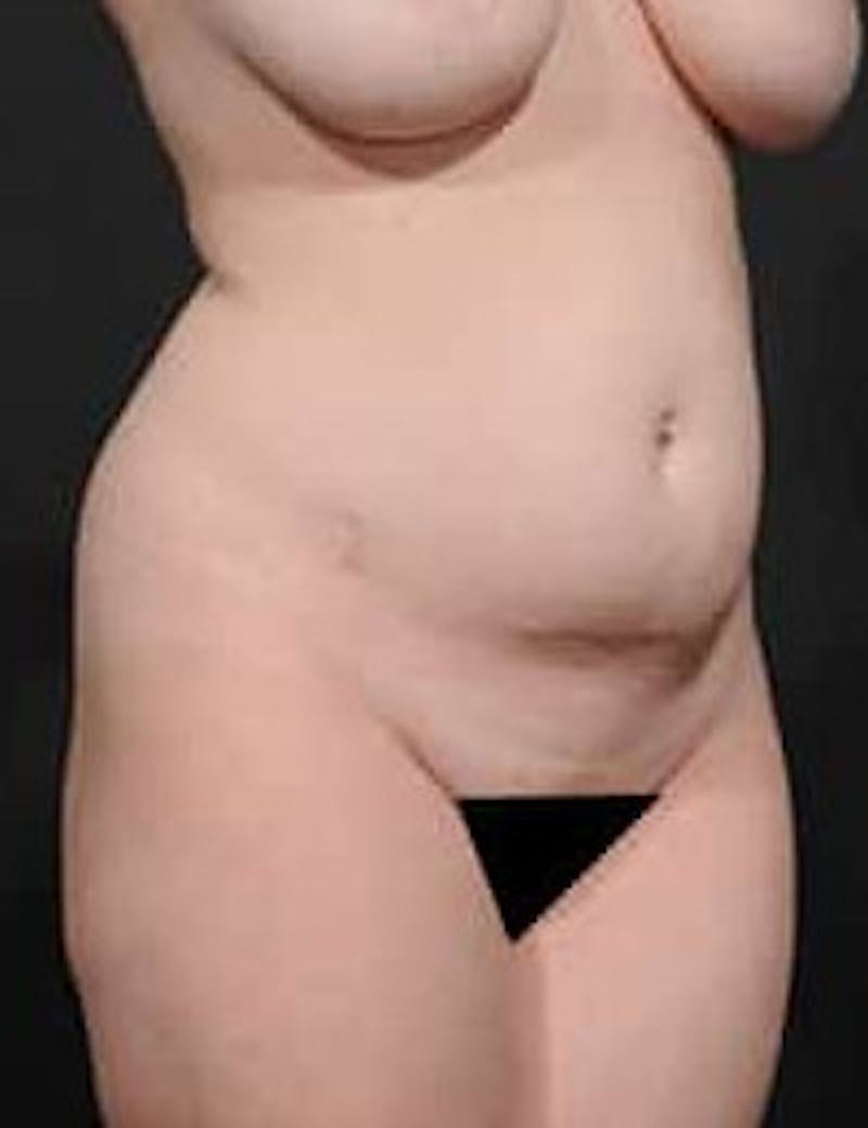 Tummy Tuck Before & After Gallery - Patient 133214397 - Image 3