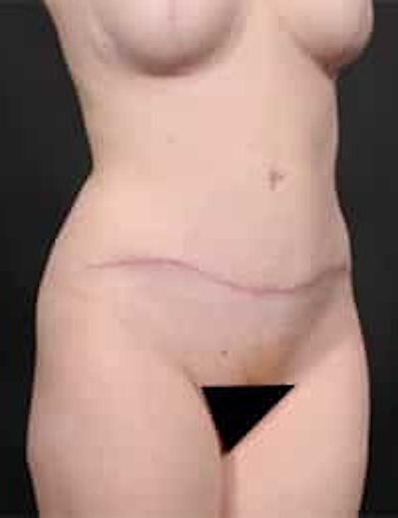 Tummy Tuck Before & After Gallery - Patient 133214397 - Image 4